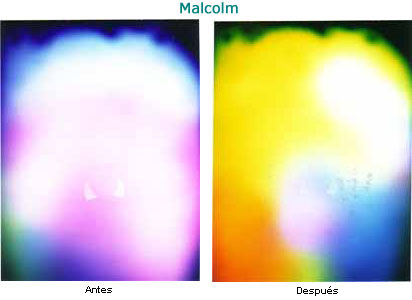 Malcolm antes y después.